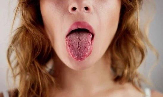 Illustration showing causes, symptoms, and management tips for dry mouth (xerostomia)